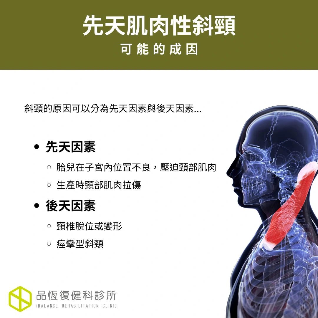 先天肌肉性斜頸 先天肌肉性斜頸