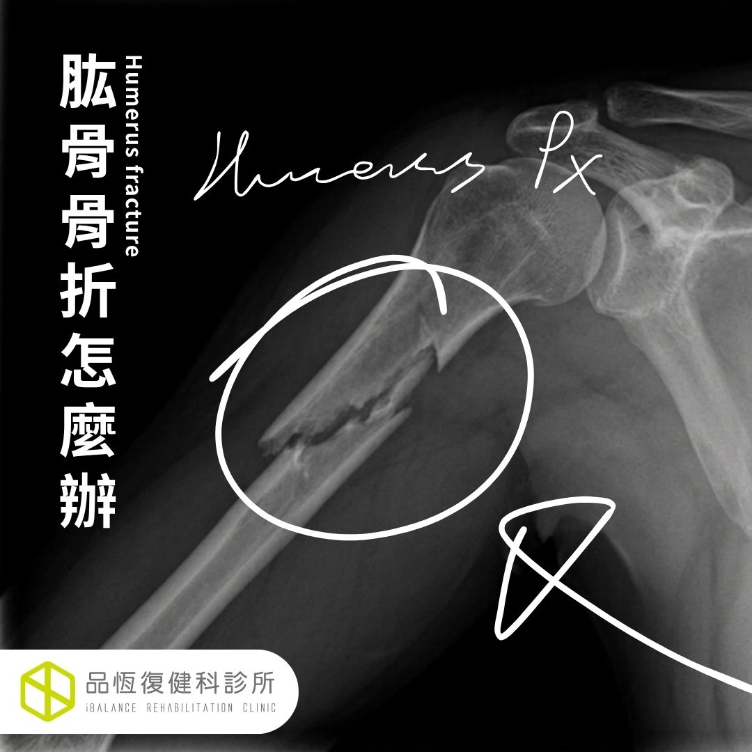肱骨骨折怎麼辦? 肱骨骨折怎麼辦?