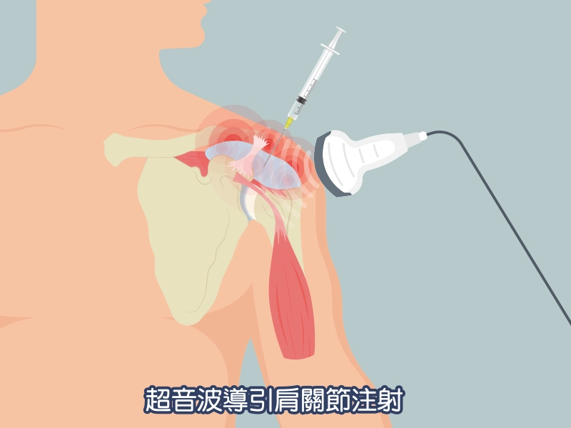 五十肩(肩關節沾粘) 五十肩(肩關節沾粘)