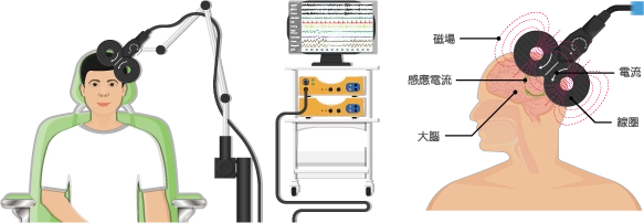 rTMS重複經顱磁刺激治療-中風後的復健新助力 rTMS重複經顱磁刺激治療-中風後的復健新助力