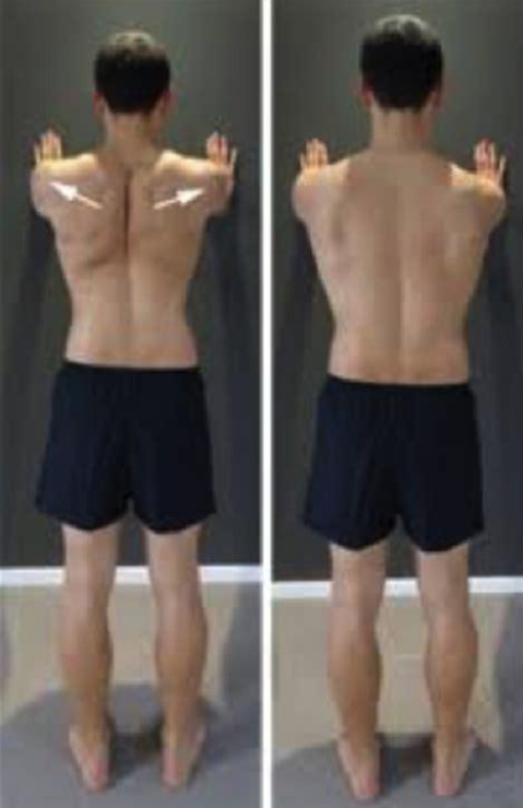肩峰下夾擠症候群 Shoulder Impingement Syndrome 肩峰下夾擠症候群 Shoulder Impingement Syndrome
