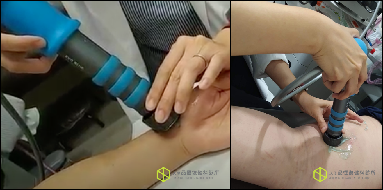 震波治療－淋巴水腫篇