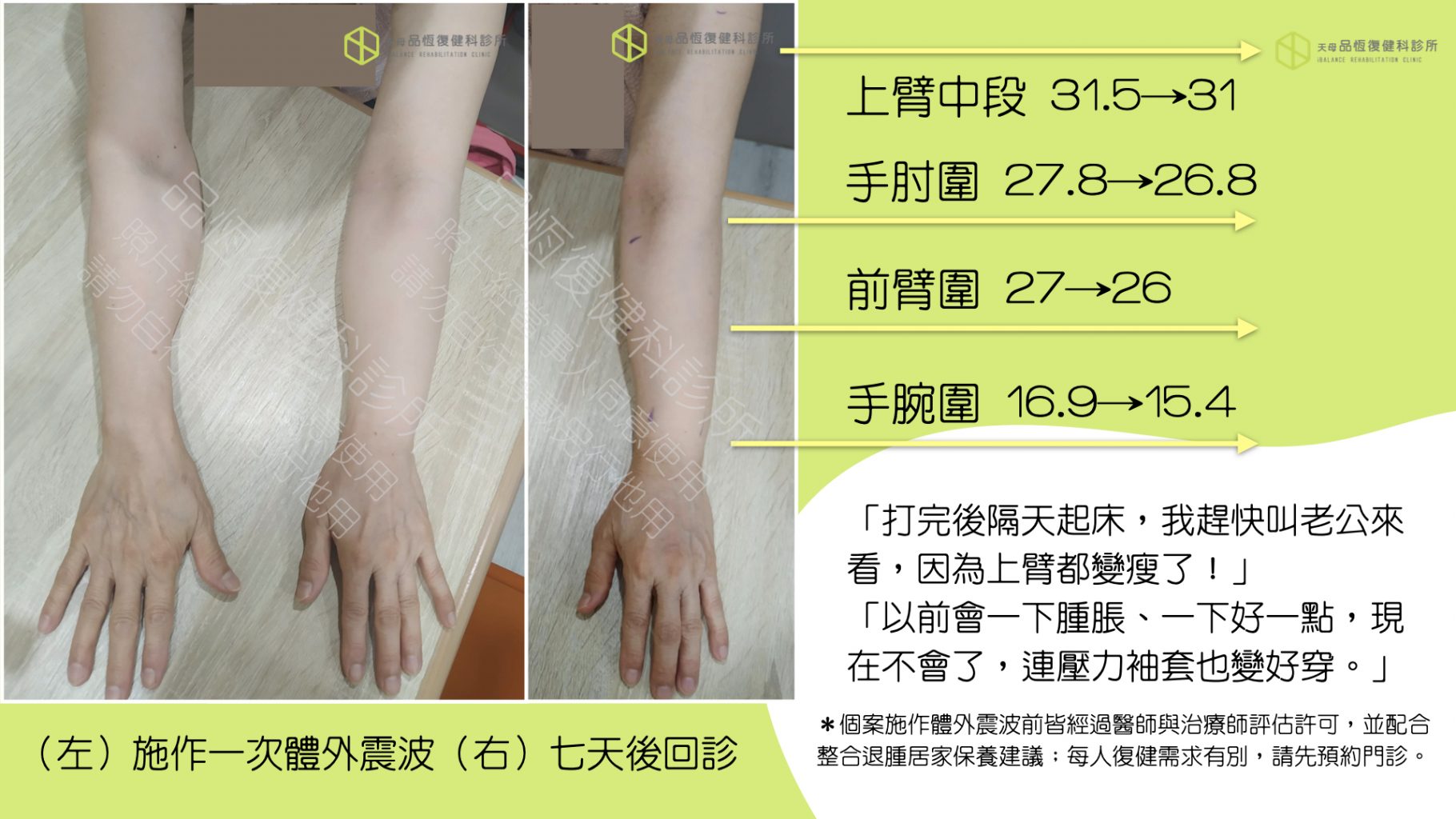 震波治療－淋巴水腫篇