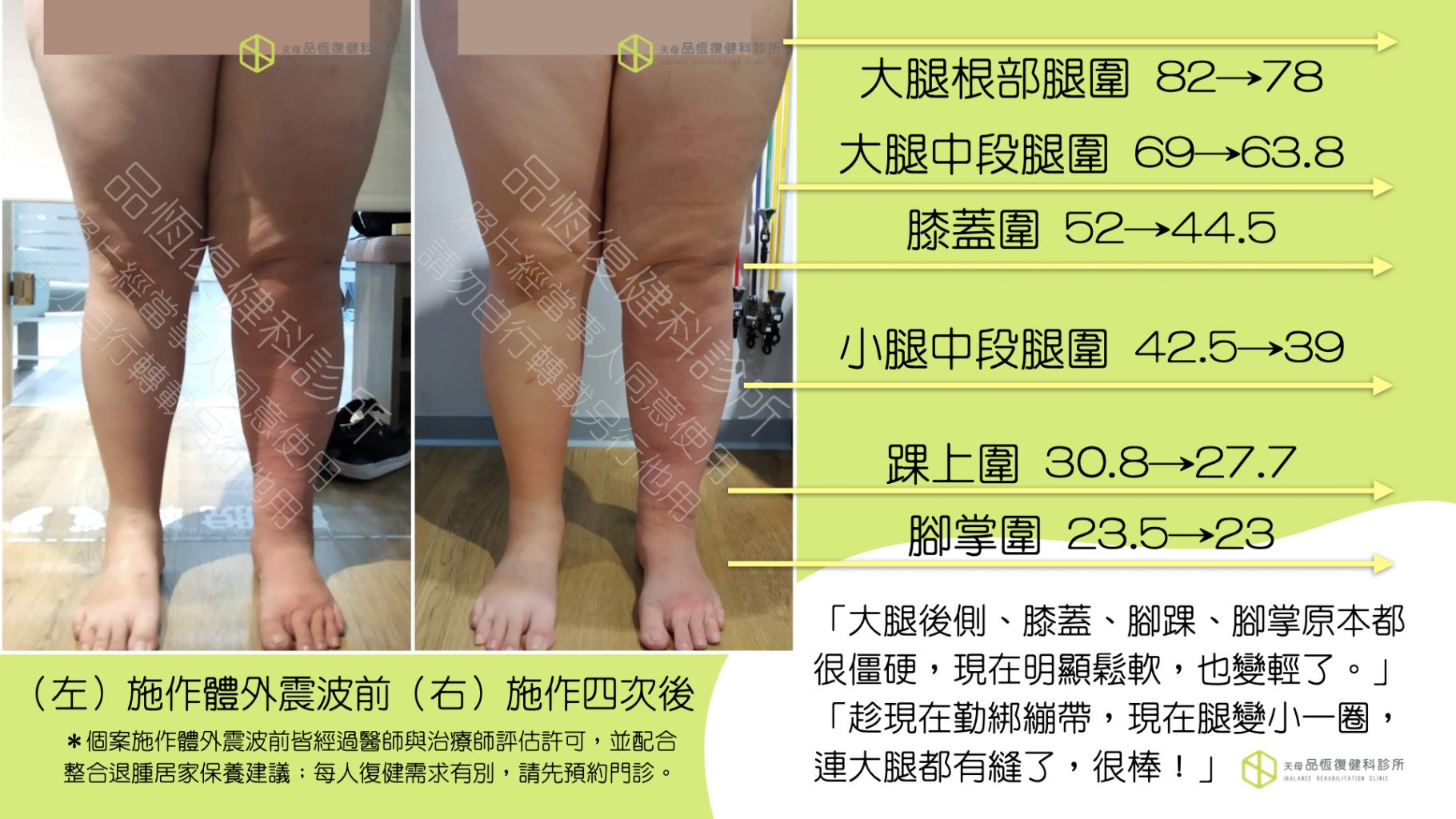 震波治療－淋巴水腫篇