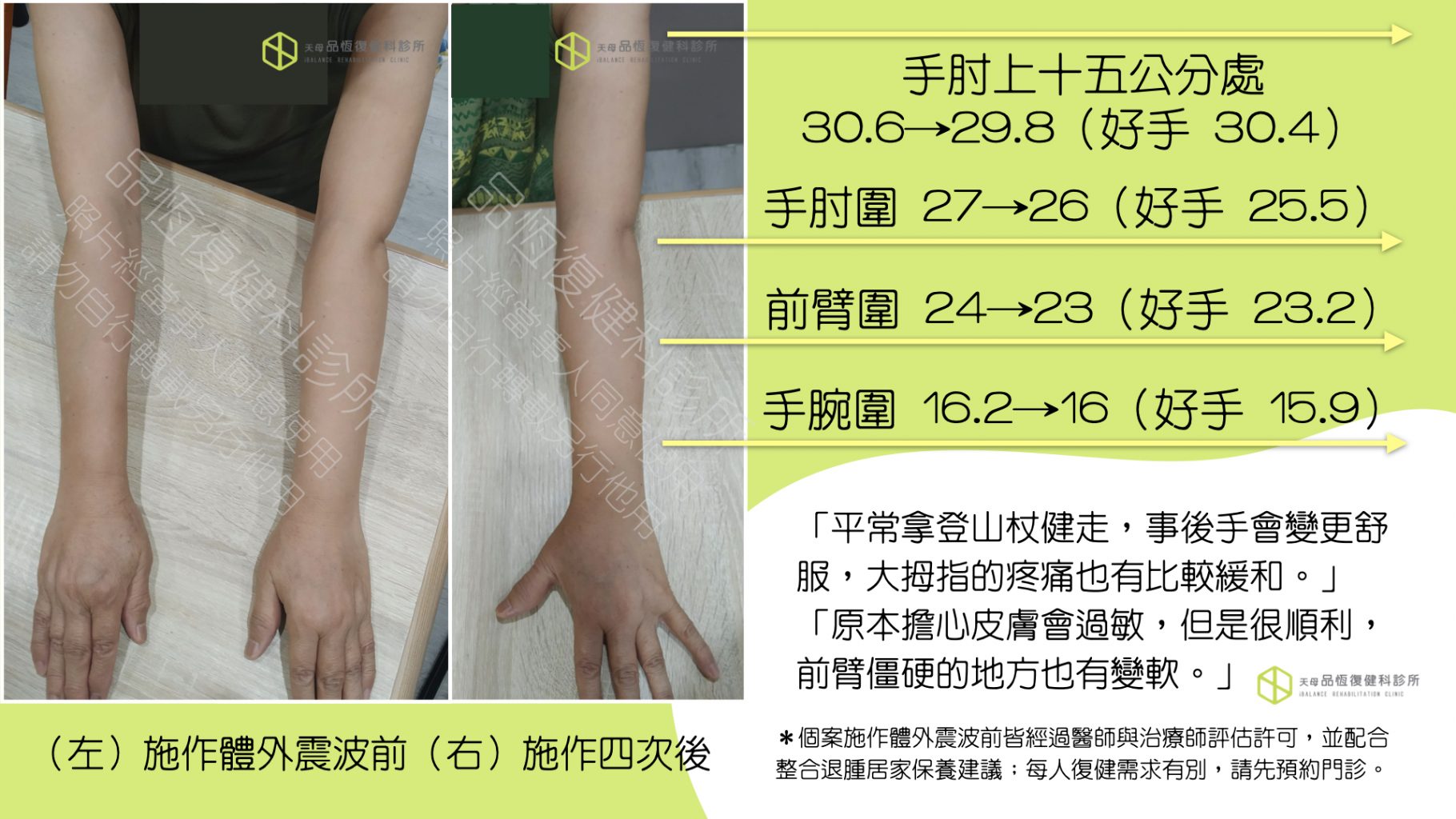 震波治療－淋巴水腫篇