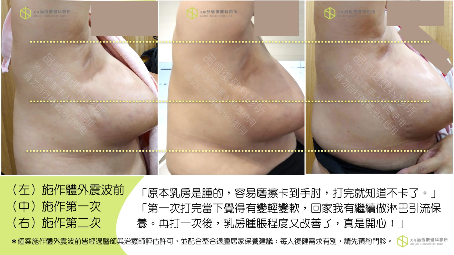 震波治療－淋巴水腫篇