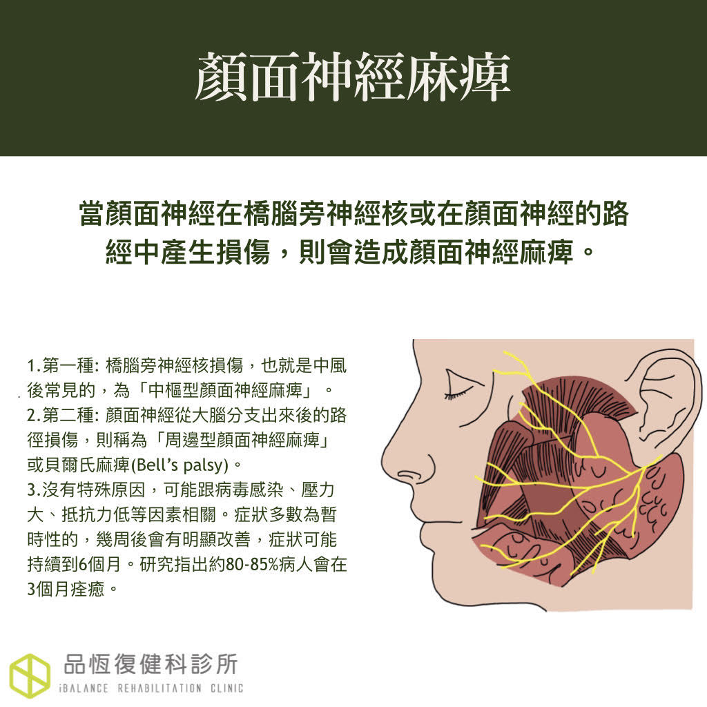 顏面神經麻痺 顏面神經麻痺